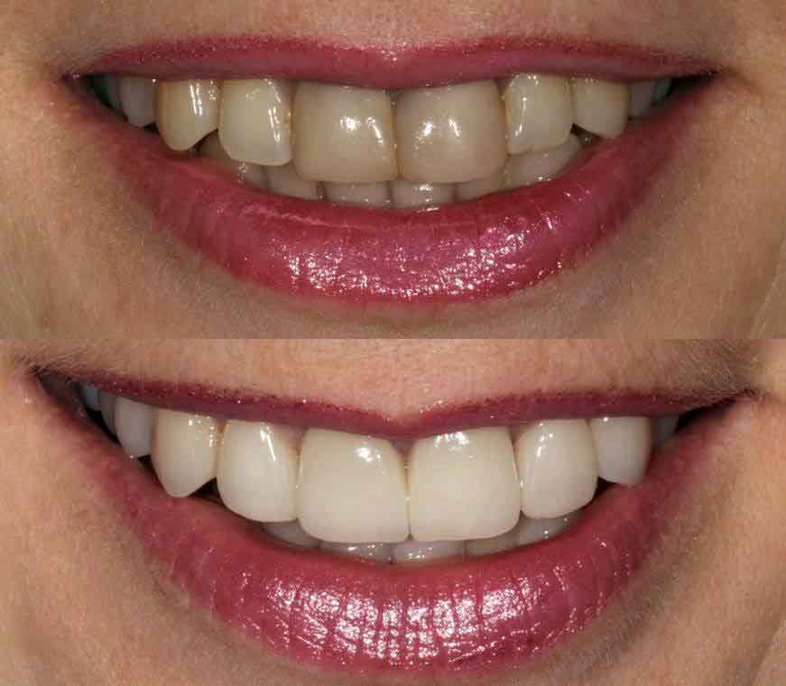 Como mejorar el color de los dientes. - White Smile Estetica Dental